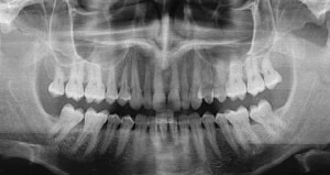 Frontal X-ray of teeth in the mouth.