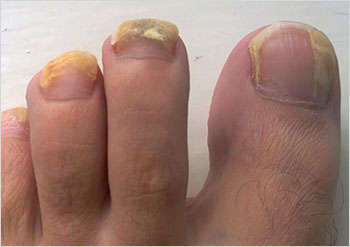 Toenail fungus