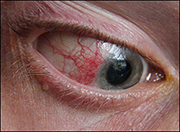 Episcleritis